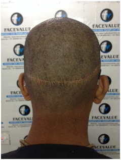 Before-DHI-Direct-Hair -Implantation-Hair-Transplant-in-Miraroad-Face-Value-Clinic